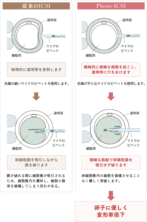 従来のICSIとピエゾICSI